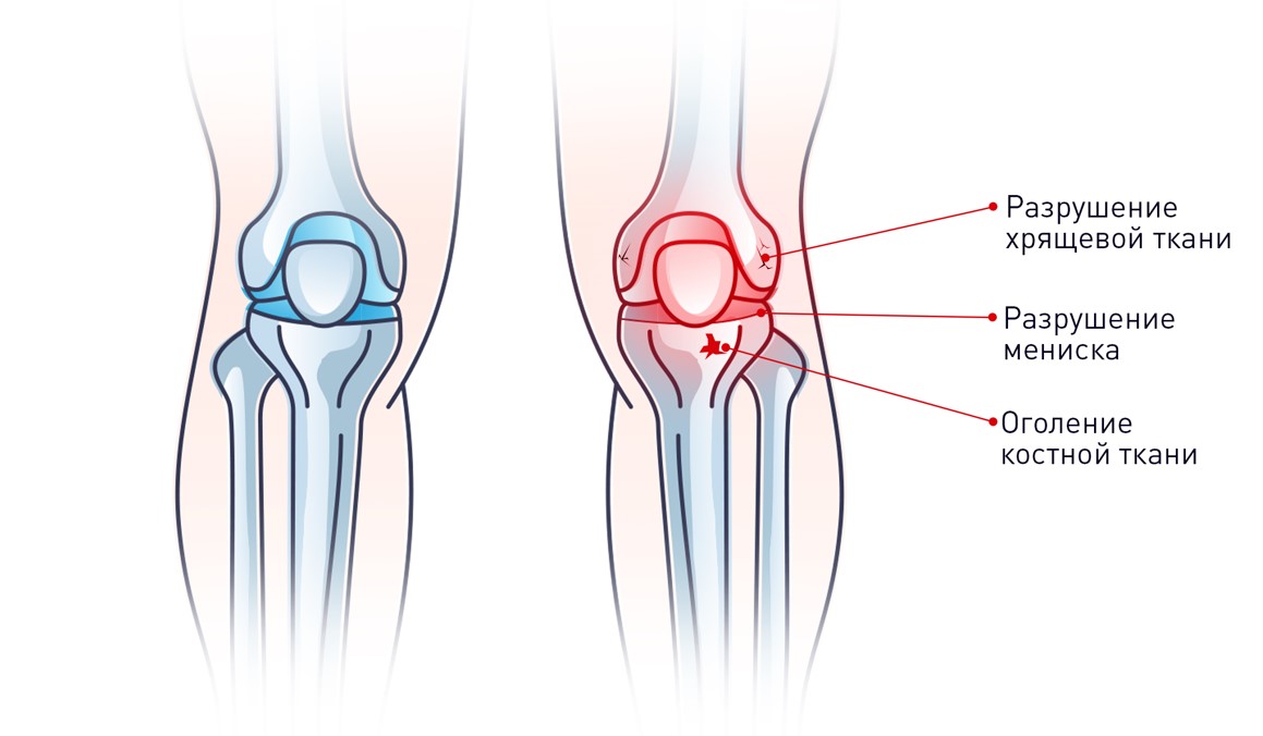 Артроз коленного сустава картинки