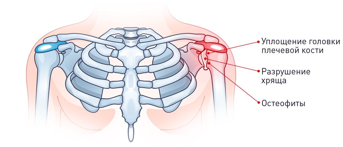 Артроз плечевого сустава 2 степени что это такое и лечение фото