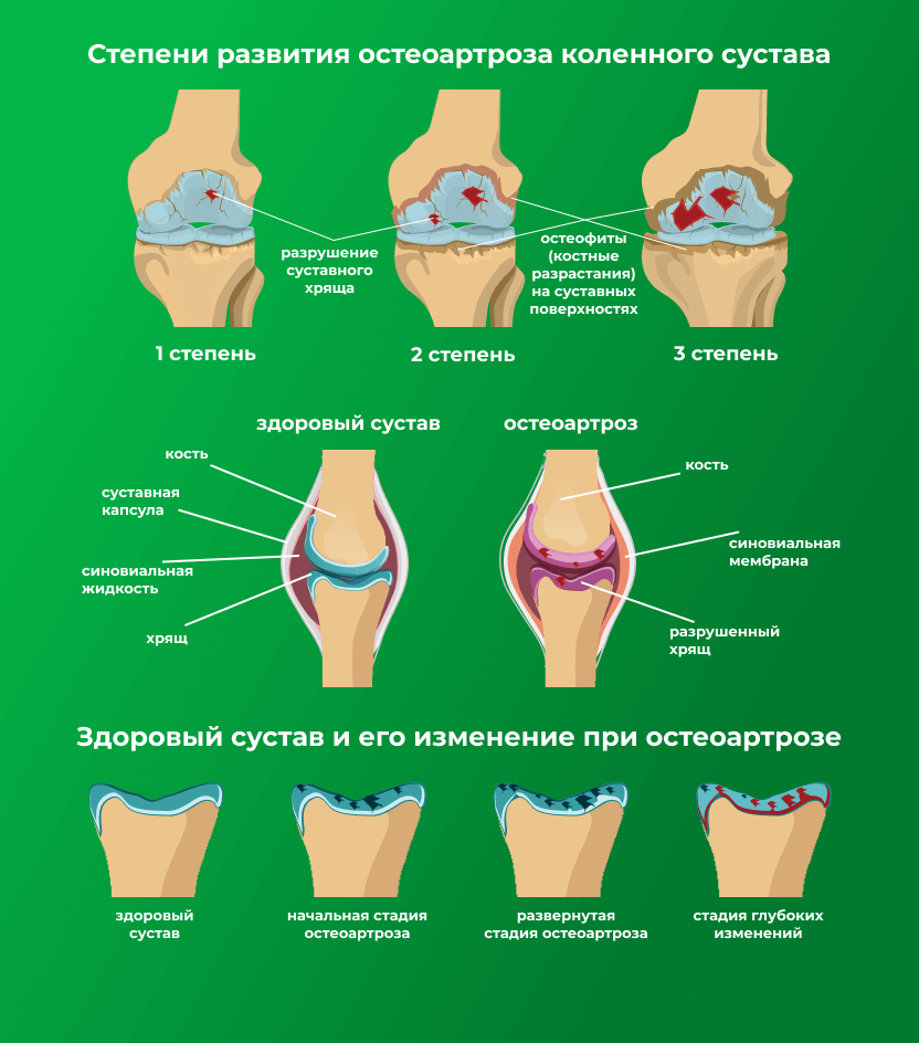 Остеоартроз классификация