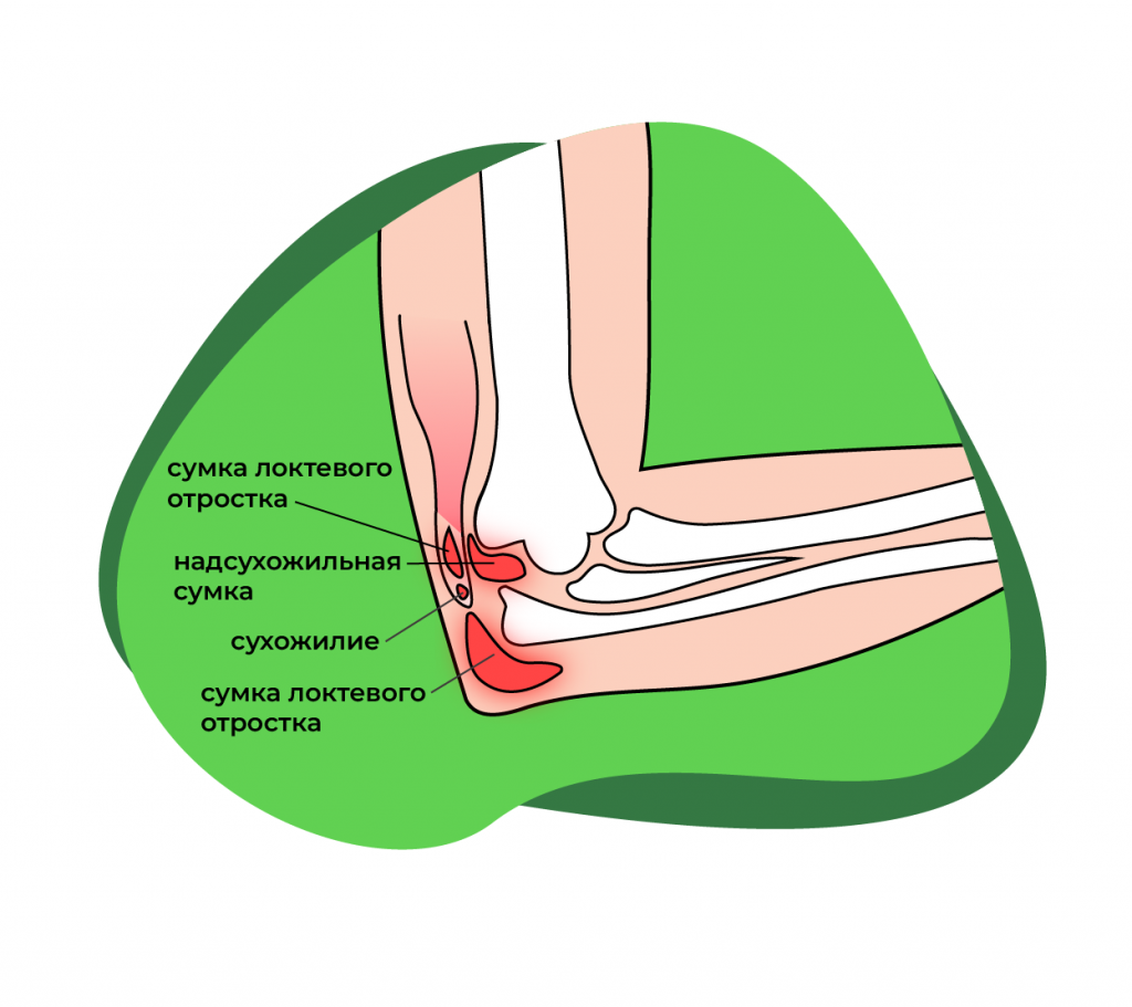 Бурсит локтевого отростка. Сумки локтевого сустава анатомия. Бурмит отростка локтевого. Синовиальные сумки локтевого сустава.
